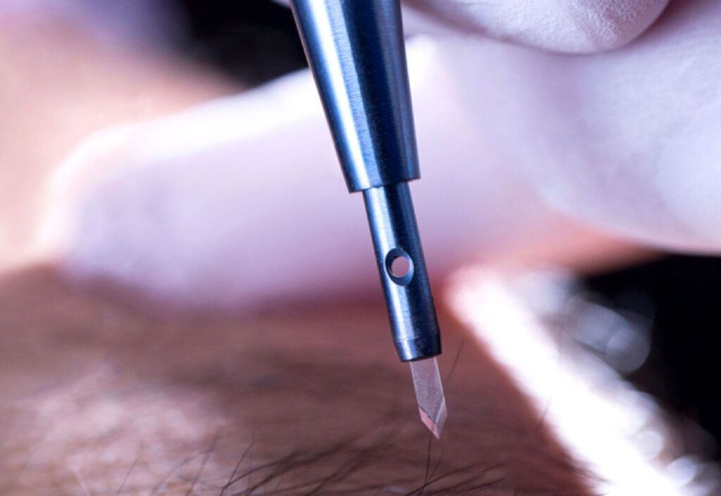 greffe de cheveux fue en turquie