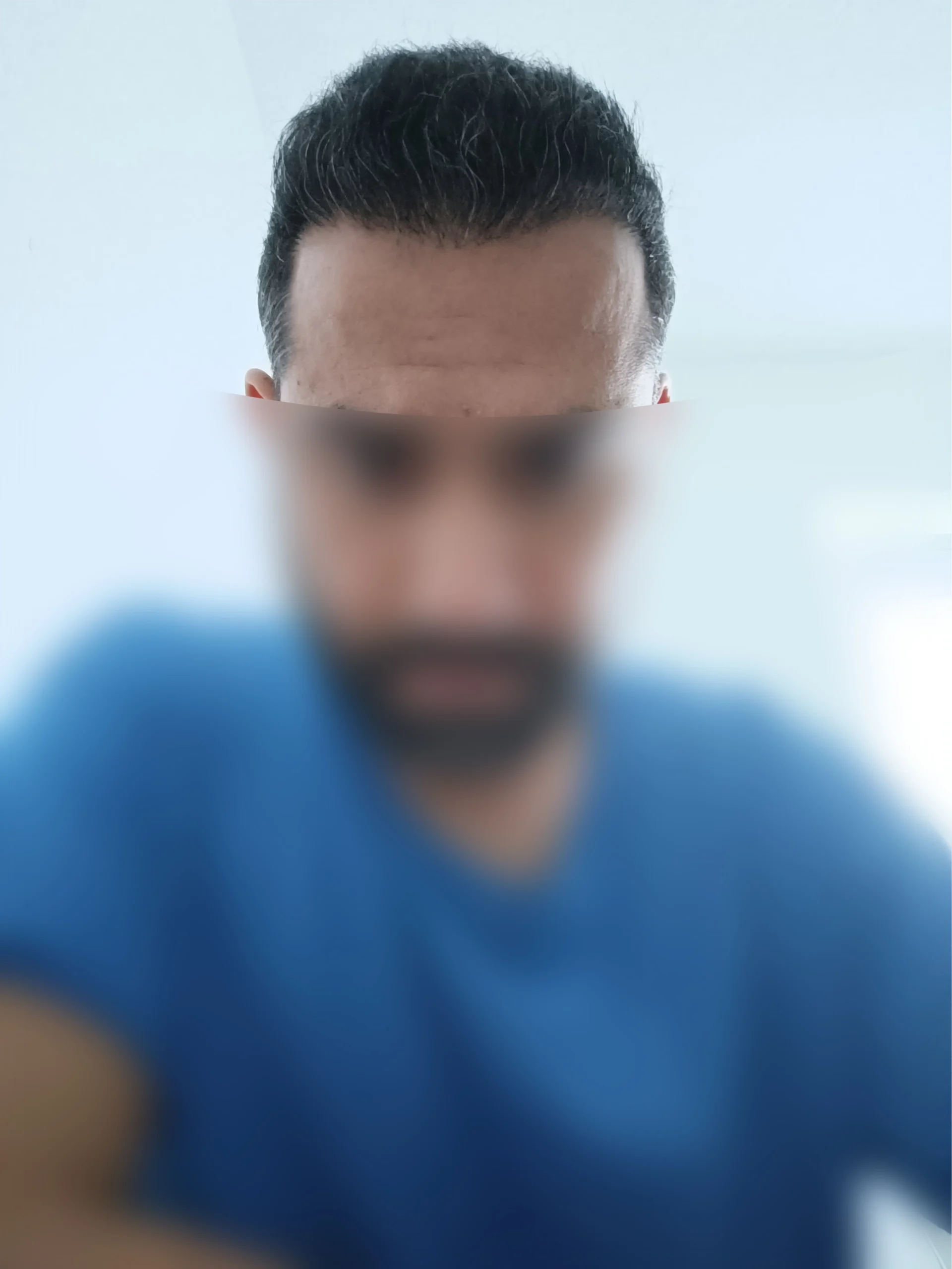 Greffe de cheveux FUE en Turquie